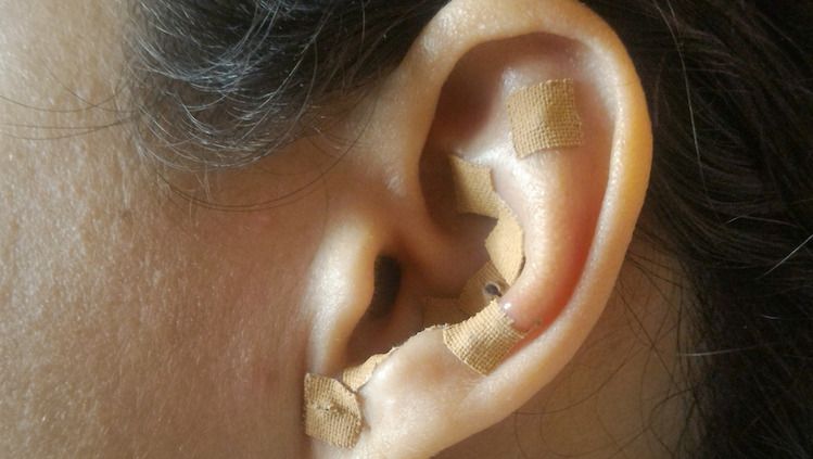 ear seed acupuncture benefits